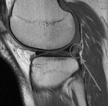 Loose Body Posterolateral Compartment Sagittal